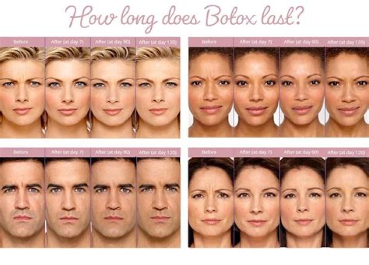 Does Botox look weird after?
