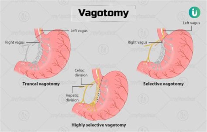 What is Vegectomy?