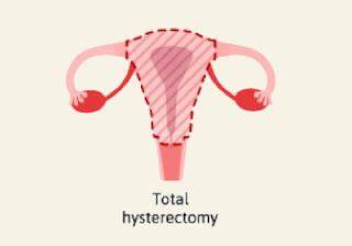 Why is my stomach bigger after a hysterectomy?